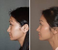 Nose jobs aren't meant to completely change your face and any reputable surgeon will tell you that good plastic surgery should make it impossible to tell i'll admit, my surgeon talked me through all of that, but as someone that had marveled over before and after pictures online (symmetrical noses. 3 Most Commonly Requested Asian Cosmetic Procedures At Changes Plastic Surgery San Diego
