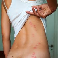 Learn how to minimize and treat bed bug bite scars. Bedbugs How To Get Rid Of Them Bite Treatment Signs Pictures