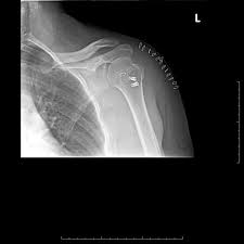 Chia sẻ chi tiết hình ảnh về bầu đức hagl không phải ai cũng biết. Hagl With Avulsion Fracture Of Humerus Radiology Case Radiopaedia Org