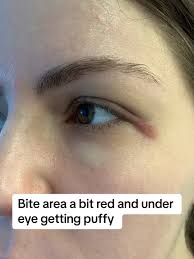 Image result for yellow sac spider bite skin