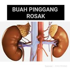 Tekanan berlebihan kepada buah pinggang adalah antara punca berlakunya kerosakan buah pinggang. Buah Pinggang Rosak