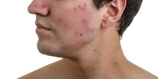 Mendapatkan cukup vitamin e sangat penting untuk sistem kekebalan tubuh, kesehatan pembuluh darah, dan kesehatan kulit. 7 Makanan Penyebab Timbulnya Jerawat Ketahui Agar Dapat Dicegah Merdeka Com