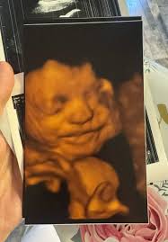 28 Weeks Anterior Placenta 3d 4d Ultrasound