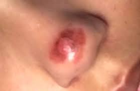Als pickel bezeichnet man störungen des hautbildes, welche meist auf hormonelle schwankungen, verunreinigungen oder die ernährung zurückzuführen sind. Fleck Nachdem Ich Pickel Ausgedruckt Habe Gesundheit Und Medizin