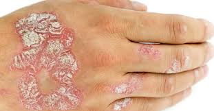 A psoríase é uma doença inflamatória autoimune caracterizada pela formação de zonas avermelhadas, escamosas e pruriginosas sobre a pele. Tipos De Psoriase Leve Tratamento Sintomas E Imagens Respostas Sempre Atualizadas