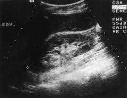 Gouva c., nikolopoulos p., ionnidis j., siamopoulos k. Ultrasonography In Chronic Renal Failure European Journal Of Radiology