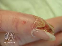 Sudden changes in skin color and formation of tiny red spots are some of the common symptoms of skin cancer. Skin Cancer Image Gallery Pictures And Photos