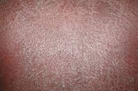 Dermatite Esfoliativa O Que E Sintomas E Como Tratar Tua Saude