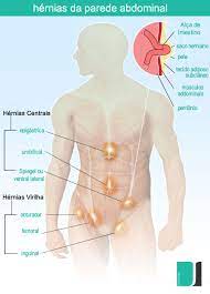 Hernia Inguinal Fernando Alberto Gomes Dr Joao Couto Neto Cirurgia Geral Hernia Vesicula E Refluxo