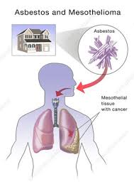 Maybe you would like to learn more about one of these? Asbestos And Mesothelioma Illustration Stock Image C027 6617 Science Photo Library