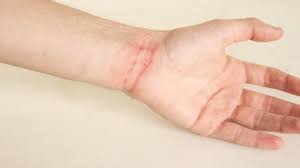 Image result for scabies on human skin