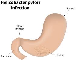 Pylori, a study found that consuming broccoli sprouts can reduce the h. Helicobacter Pylori Jackson Siegelbaum Gastroenterology