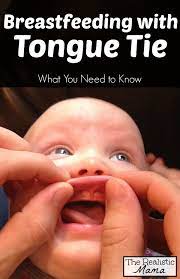 This can contribute to tooth decay and inflammation of the gums (gingivitis). Tongue Tied Baby What You Should Know The Realistic Mama