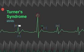 Turners Syndrome By Prezi User On Prezi