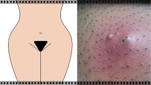 The hair also aids in natural hygiene. How To Shave Your Pubic Hair Without Getting Razor Bumps Healthy Living Tips