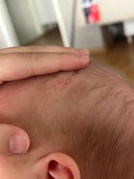 Image result for sores on the head in children