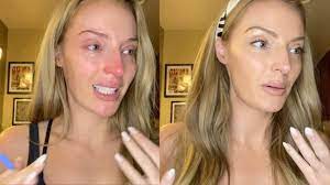 How To Get Rid Of Puffy Eyes From Crying - Youtube