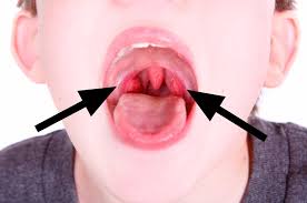 Pfeiffersches drüsenfieber (blut im mund)? Mandelentzundung Streptokokken Angina