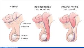 Image result for Inguinal hernia man