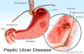 Peptic Ulcer Peptic Ulcer Stomach Ulcers Ulcers