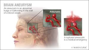 A ruptured aneurysm is a life threatening condition that can cause serious brain injuries or stroke. Brain Aneurysm The Neurology Group