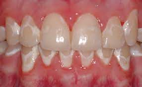 Parents often wonder how to get off white spots on teeth from braces. White Spots On Teeth Viechnicki Orthodontics Bethlehem Pa