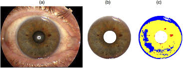 Check spelling or type a new query. Novel Quantitative Pigmentation Phenotyping Enhances Genetic Association Epistasis And Prediction Of Human Eye Colour Scientific Reports