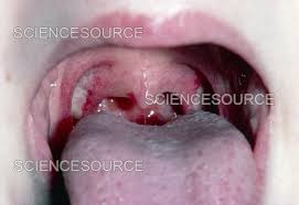 Image result for Tonsillectomy