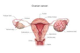 Find clinical trials for ovarian cancer. Ovarian Cancer Signs Symptoms And Diagnosis Saint John S Cancer Institute Santa Monica Ca