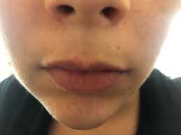 We did not find results for: Skin Concerns My Top Lip Skin Is Slowly Disappearing I Get Red Or White Spots On My Lips For Months At A Time And When The Spots Go Away It Appears That