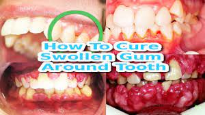 The good news is periodontal disease—a tooth abscess to you and i—can be treated to relieve pain and swelling and deal with a gum infection at home, so you don't need to run to the dentist every time you're suffering. Home Remedies For Gum Pain And Swelling Fastest Way To Treat Swollen Gums At Home Steemit