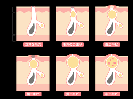 よもぎ蒸しで肌荒れ・アトピーをケア！体の内側から美肌を目指す方法 | タイ古式マッサージ・脱毛・よもぎ蒸しのお店 | ReCure～リキュア～  ブックスなにわ古川店内