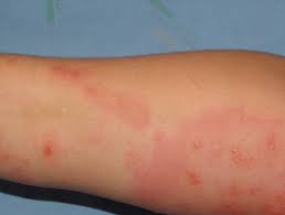 The only time i have had all over itching without a rash was from dry skin. The Differential Diagnosis Of Itchy Skin Dermnet Nz