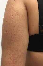 A Dermatologists Breaks Down The Reasons Your Skin Has Red Bumps Skin Bumps Chicken Skin Remedy Skin Spots