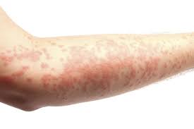 Rash And Inflammation While On Lamictal