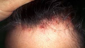 These are few of the signs and symptoms of an ingrown hair the main cause of ingrown hair is faulty hair removal practices. Scalp Folliculitis Symptoms Pictures Causes Shampoos And Creams
