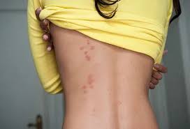 Image result for Cimex lectularius bites