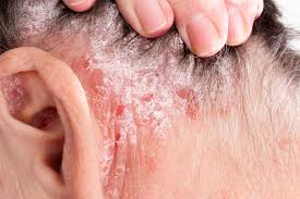 Image result for psoriasis