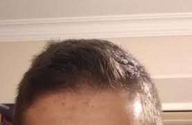 A man with thinning hair. What Is Wrong With My Hair Quora