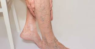 The most effective way to prevent poor circulation in your legs or improve your symptoms is to avoid spending hours sitting in the same position. 10 Home Remedies For Varicose Veins