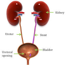 As my cat is 23, surgery is not an option for bladder stones. Treating Feline Ureteral Obstruction Veterinary Practice