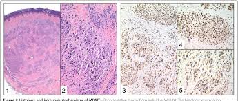 Bap1 immunohistochemistry has limited prognostic utility as a . Figure 2 From Bap1 Cancer Syndrome Malignant Mesothelioma Uveal And Cutaneous Melanoma And Mbaits Semantic Scholar