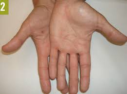 Home remedies for knuckle joint pain swelling are warm and cold compresses, physical therapy and applying aloe vera gel. Collection Of Conditions Affecting The Hands Consultant360