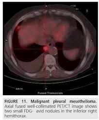 We did not find results for: Diagnostic Imaging And Workup Of Malignant Pleural Mesothelioma
