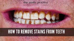 May 12, 2018 · share on pinterest black teeth may be caused by tartar buildup and stains. How To Remove Stains From Teeth The Smile Practice