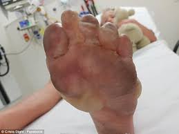 Young kid feet in bed. Little Boy Is Left With Horror Burns On Is Feet After Standing On A Extinguished Fire In Queensland Daily Mail Online