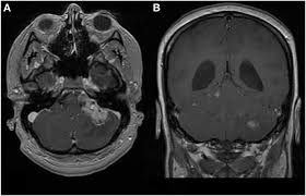 Check with your child's doctor if your child has any of the following: Frontiers Atypical Teratoid Rhabdoid Tumor Two Case Reports And An Analysis Of Adult Cases With Implications For Pathophysiology And Treatment Neurology