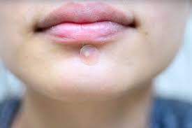 Maybe you would like to learn more about one of these? 5 Rekomendasi Acne Patch Yang Bisa Menutupi Jerawatmu