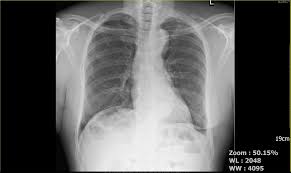 Treatment involves a course of specialized antibiotics under close medical supervision, along with rest and supportive care. Medpix Case Rib Fractures Posterior At Left 3rd Rib Laterally On Left 5th 9th Ribs Incidental Findings Of Ascending Thoracic Aneurysm And Hiatal Hernia