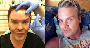 Svenske Robin är beroende av skönhetsingrepp: "Vill se ut som en  porslinsdocka"